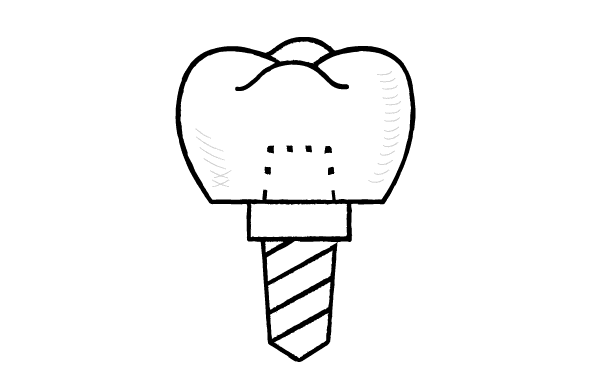 インプラント治療